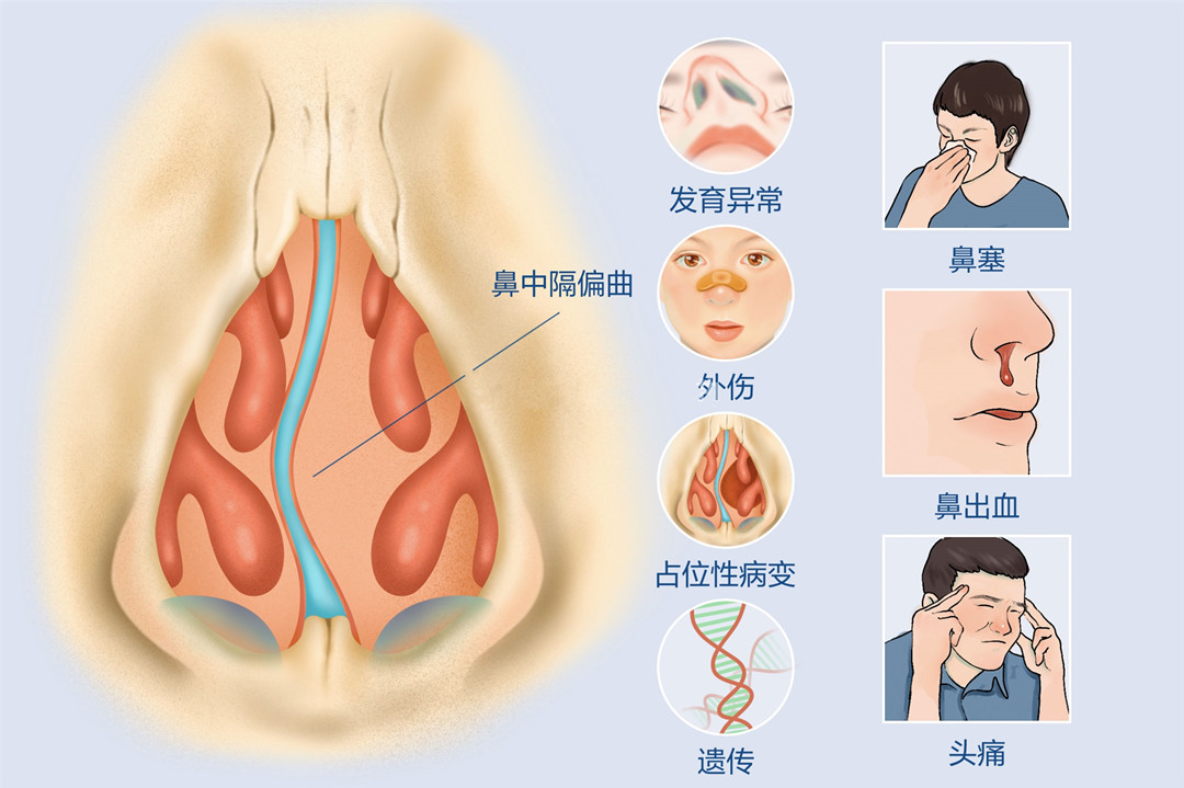 成都鼻子歪了还能复原吗？